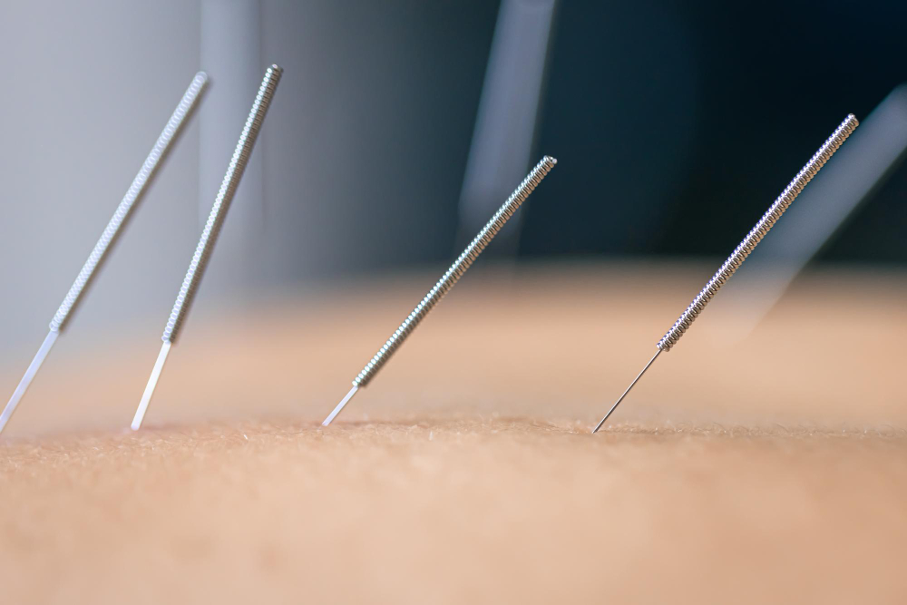 Acupuncture Northfield, MN